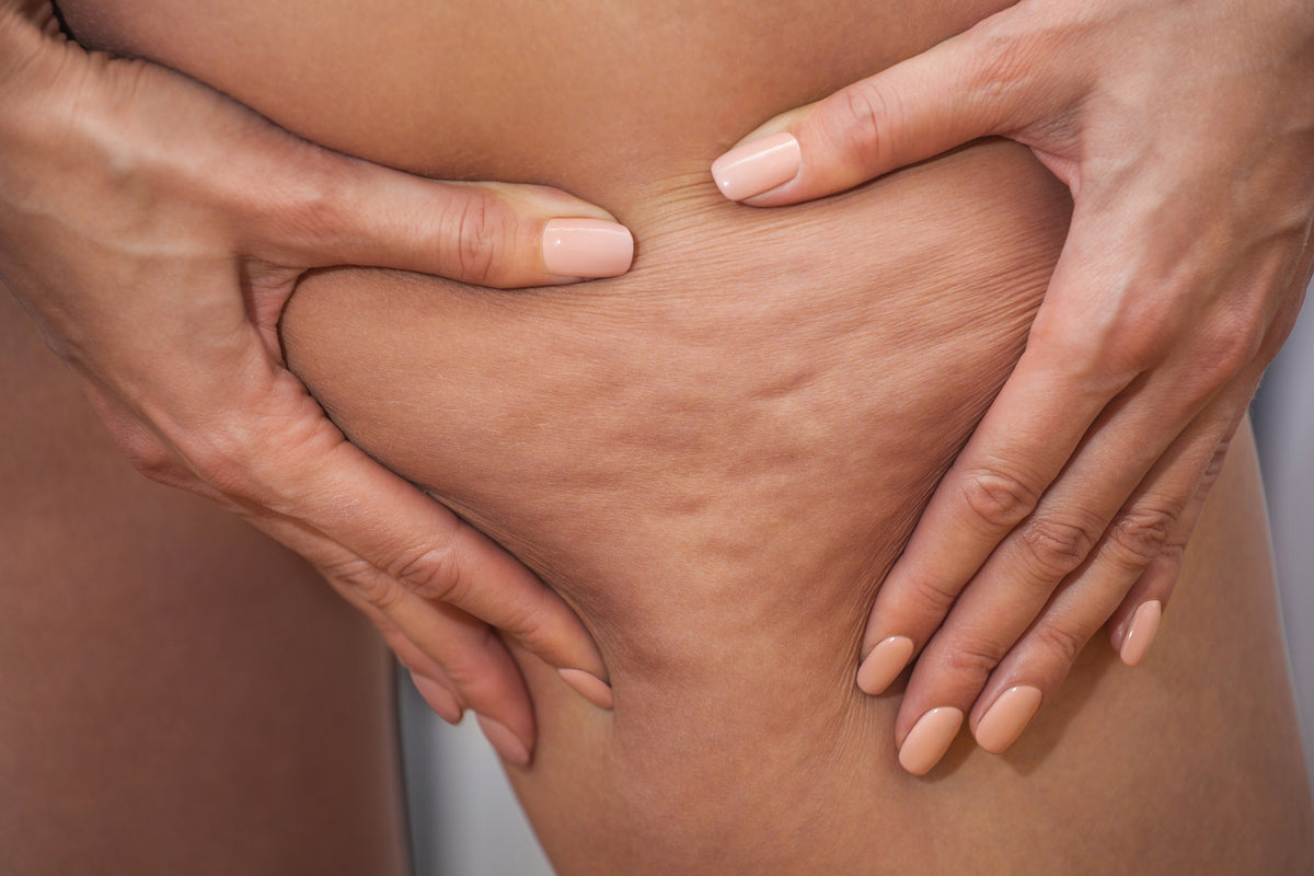 Close-up of cellulite on the leg