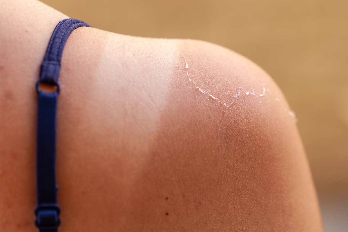 Sonnenbrand Woman with sunburn on her shoulder